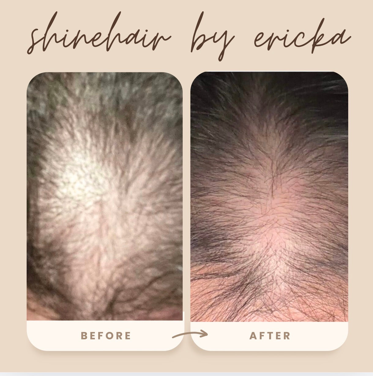 SHINEHAIR SCALP THERAPY